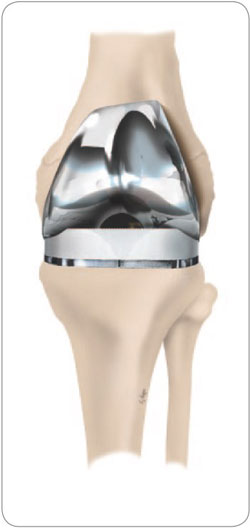 Implantiertes künstliches Kniegelenk