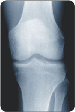 Röntgen gesundes Knie