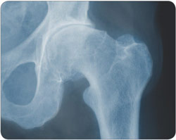 Röntgenbild Arthrosehüfte
